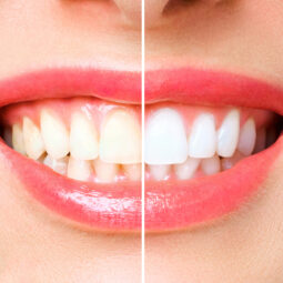 woman teeth before and after whitening. Over white background. Dental clinic patient. Image symbolizes oral care dentistry, stomatology.