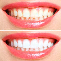 woman teeth before and after whitening. Over white background. Dental clinic patient. Image symbolizes oral care dentistry, stomatology.
